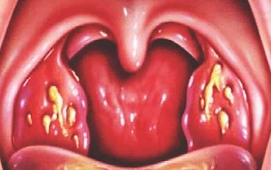 Effectiveness of Ayurvedic Intervention in the Management of Chronic Tonsillitis