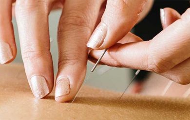 Acupuncture: The Art of Inserting Needles