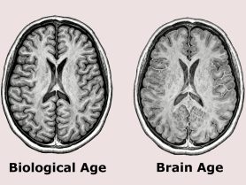 Brain Age vs Biological Age: Why Your Brain May Age Faster